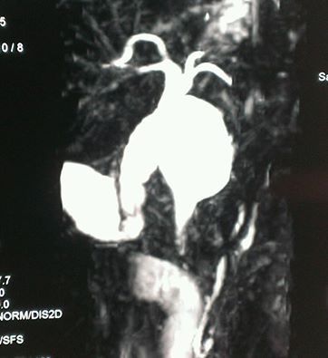 Choledochal Cyst