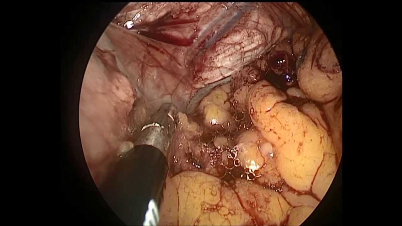 GIST: Gastrointestinal stromal tumors